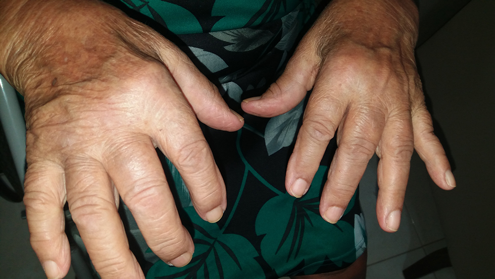 Fingers showing chronic chikungunya arthritis.